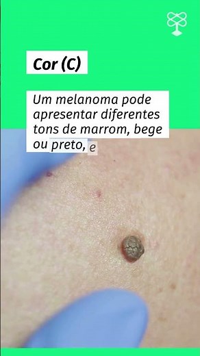 Como saber se uma mancha ou pinta é sinal de câncer de pele