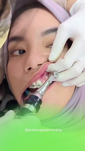 Fungsi Mini Screw dalam Ortodontik