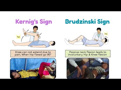 Kernig’s Sign & Brudzinski’s Sign Explained | Meningitis Clinical Signs Simplified