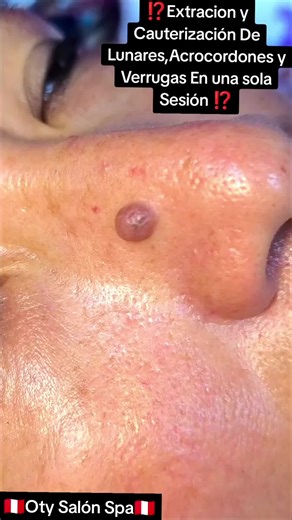 Cauterización y Eliminación de Lunares y Verrugas
