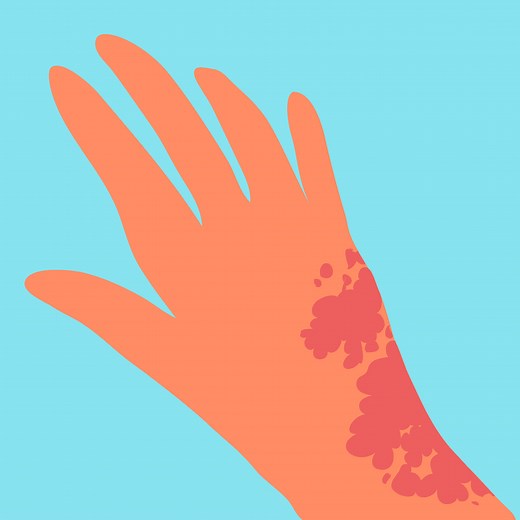 Psoriasis: Overview and More