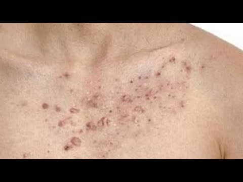 Blackhead Removal on CHEST - ACNE Treatment for Blackheads, Whiteheads, Milia