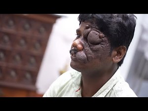 Facial Tumor Removal from Face Complete Consultation | Dr. Sunil Richardson