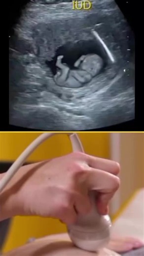 pregnancy ultrasound #pregnancy #gender #normaldilivery #reproduction