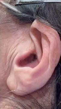 Successful Removal of Crusted Ear Blockage in Elderly Woman With CSOM History.