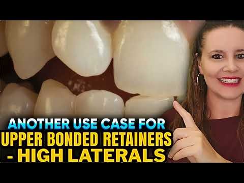 High Lateral Incisors and Bonded Retainers, Fixed Retainers 3-3 Upper Retainer AND essix