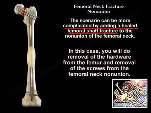 Femoral Neck Fracture Nonunion - Everything You Need To Know - Dr. Nabil Ebraheim