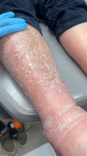 Swollen legs. Puffy feet. Socks leaving dents in your skin? 👣 That’s often caused by poor circulation in the legs (called venous insufficiency). When blood and fluid don’t move back up properly, they pool in your legs, causing: ✅ swelling ✅ pitting (when you press and it leaves a dent) ✅ heaviness or tightness What helps? 💧 Watching how much liquid you drink (not too little, not too much) 🧦 Wearing compression socks to gently push fluid back up ⬆️ Elevating your legs when you can Ignoring leg