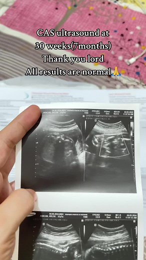 CAS Ultrasound at 30 Weeks Pregnancy: All Normal Results