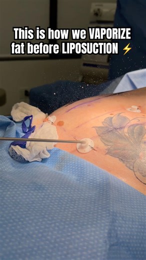 HOW we VAPORIZE FAT before LIPOSUCTION #plasticsurgery #liposuction