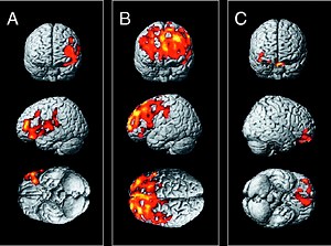 Novel Expression Sites Discovered for ALS Gene | Genetics And Genomics