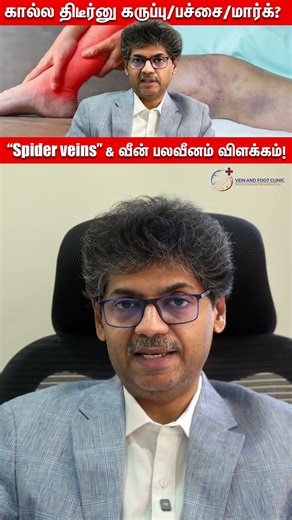 கால்ல திடீர்னு கருப்பு பாச்/மார்க்? “Spider veins” & வீன் பலவீனம் விளக்கம்! | DR Balakumar