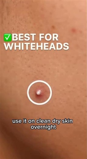 I Tried The Pimples Patch—This How It Works 😱. #pimplepatch #pimplepatches #pimples #skincare #fyp