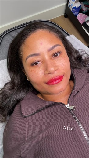 Dark Lips Neutralization Treatment: Before and After Results