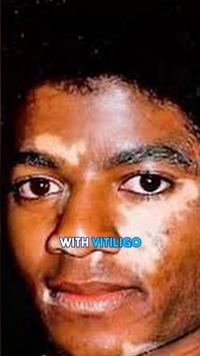 The dark secret behind Michael Jackson's glove... #shorts #viral #vitíligo #jackson #michaeljackson
