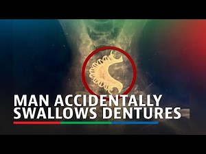 Elderly man who accidentally swallowed his dentures saved by doctors in Peru | ABS-CBN News