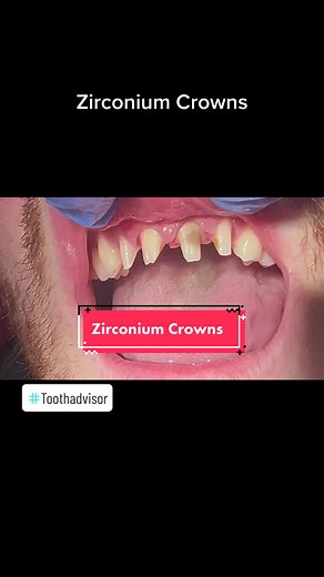 Zirconium crowns uk Made with digital technology Fitted and the result #zirconiumcrowns #zirconium #digitaldentistry #instantteeth #smilemakeover #zirconiumcrown #crowns #dentistryuk #toothadvisor #dentaleducationuk
