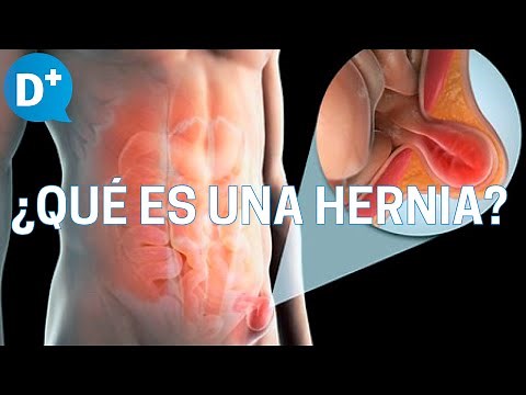 Hernias: ¿Qué es una hernia y por qué se produce?