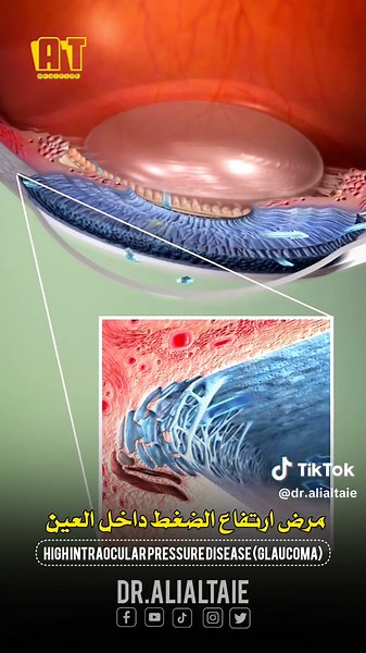 الجلوكوما: كيفية ارتفاع الضغط داخل العين