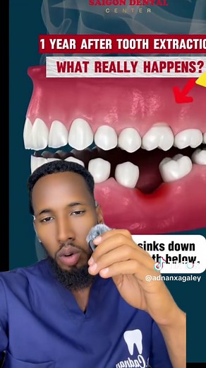 Consequences of Tooth Extraction: One Year Later