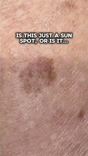 Sun spots and melanoma (a skin cancer) can look similar