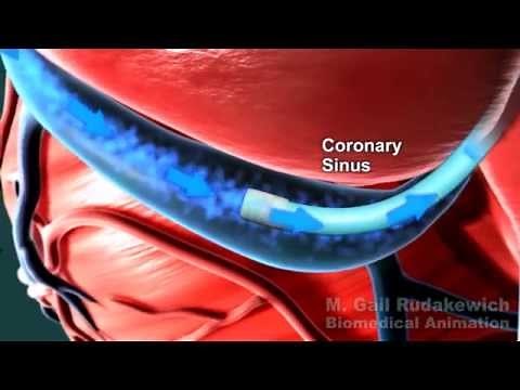 Neovasc Reducer Animation