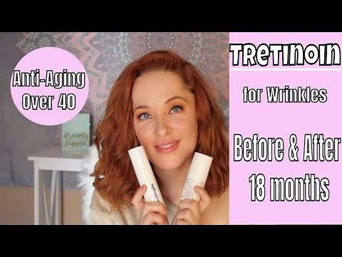 TRETINOIN BEFORE & AFTER - 18 MONTHS with PHOTOS!