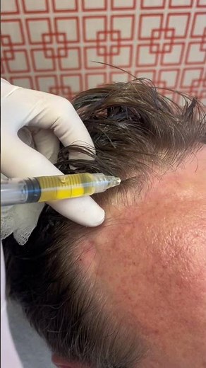 STOP Letting Hair Loss Control Your Life With Exosomes Therapy