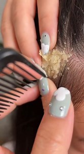 364K views · 279 reactions | asmr dandruff removal on head sister big flake (88) | Showerer | Facebook