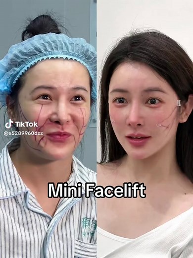 Micro face lift can solve the problem of facial sagging in 40 minutes, with minimal trauma and no downtime.#变美日记 #上海整形 #大拉皮 #無痕筋膜提升 #facelift