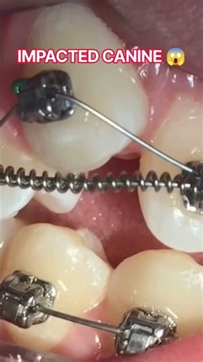 Impacted Canine Treatment 🦷 | Braces & Tooth Chain Journey | Canine Exposure & Orthodontic Treatment
