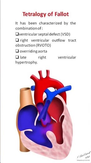 Tetralogy of fallot