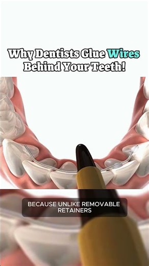 Why Dentists Glue Wires Behind Your Teeth!