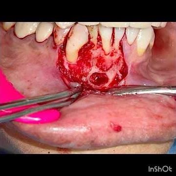 Periapical cyst #cyst removal #oralsurgeon #dentistry #cyst surgery #radicular cyst
