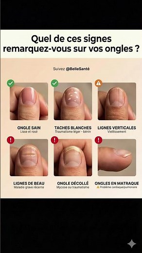 Vos ongles révèlent votre santé : 6 signes à connaître absolument