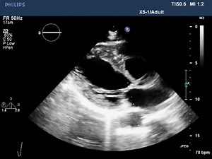 1.3K views · 18 reactions | Ultrasound Corner: Fatigue, chest tightness and heart murmur—a rare congenital valvular abnormality What's the diagnosis? Read the full research in the September issue to learn more: https://hubs.la/Q022828m0 #MedEd #JournalCHEST | American College of Chest Physicians | Facebook