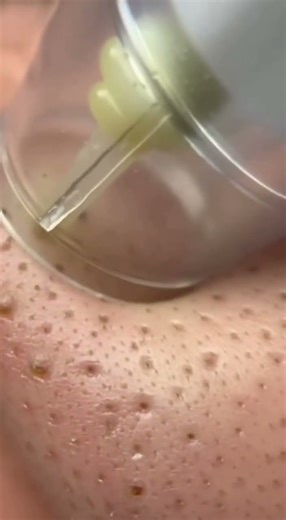 I Spent A FORTUNE On THIS Blackhead Tool... Was It Worth It?!