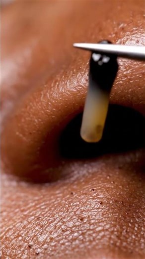 Precision Tweezers Extraction! 🎯👃✨ #PoreClean #ASMR #Satisfying