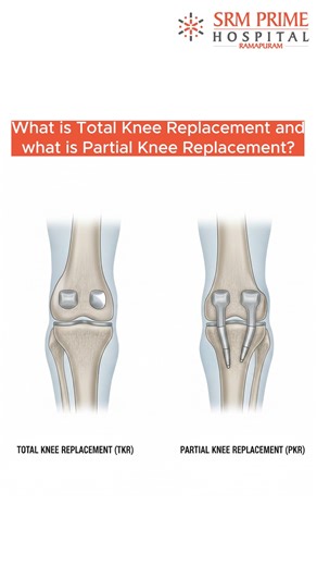 Wondering what’s the difference between Total Knee Replacement and Partial Knee Replacement? Dr. Mohan G explains the key differences, who needs which procedure, and how the right decision can improve movement and quality of life. For appointments call: 044 3545 3545 #SRMPrimeHospital #RestoringLives #HealthcareExcellence #KneeReplacement | SRM Prime Hospital, Ramapuram