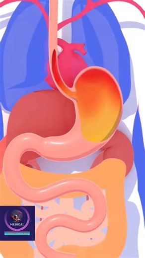 Gastric reflux explained in 3d animation. #gastricreflux #medical #animation #f#foryouシ | Medical Animation Media