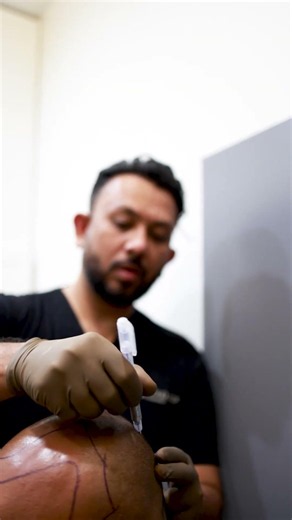 The First Step: Hair Transplant Consultation & Mapping