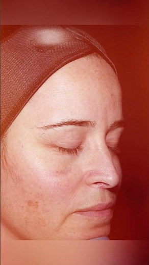 IPL Before and After Skin Transformation Intense Pulsed Light #cosmeticdermatology #beforeandafter