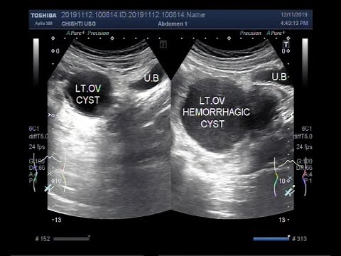 Ultrasound Video showing difference between functional ovarian cyst and Hemorrhagic Ovarian Cyst.