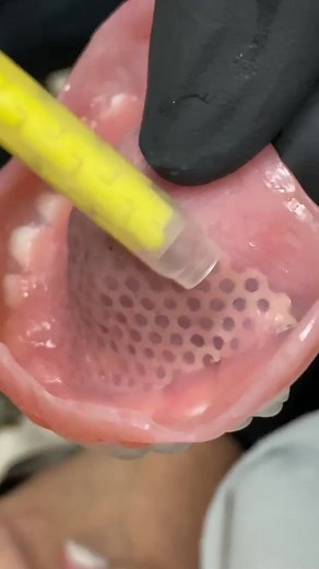 Relining a Denture - Full Process! Watch the full video at: https://youtu.be/A_RwVGRk0J4 | Luke Kahng