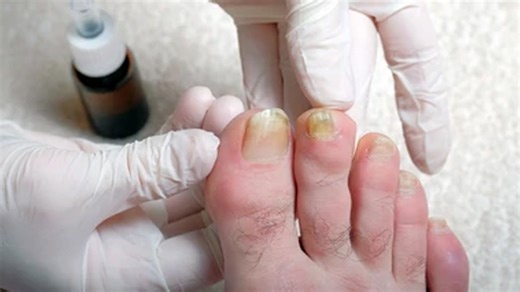 Toenail Discolouration: What Causes It And Ways To Treat It