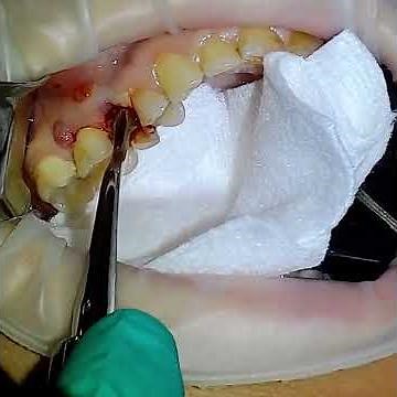 Root Removal Dental Extraction