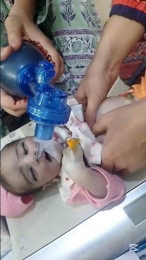 Resuscitation of the baby | Ambu bagging with CPR