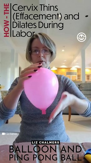 How the Cervix Effacement (Thins) and Dilates During Labor. The Ping Pong ball represents a baby, the balloon acts as an uterus and the neck of the balloon act as the cervix, the portion of the uterus that opens to allow the baby to delivery. #medED #medical #delivery #balloons #pingpong #baby | SurgMedia