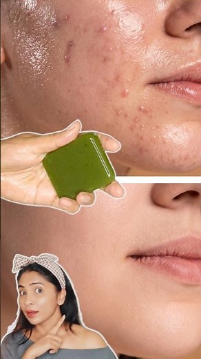 Summer Soap For Clear Skin-Neem Soap-Remove Bumps, Pimples, Whiteheads in 7 Days #homemade #diy