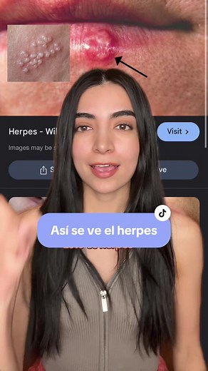 Todo sobre el herpes: síntomas, tratamiento y más